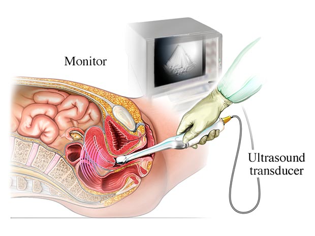 Transducer medical illustration